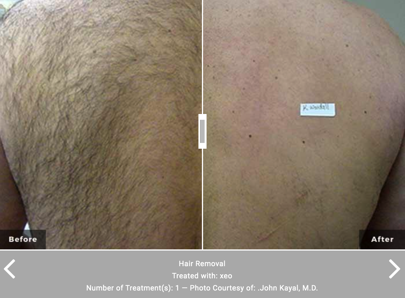 XEO Cutera Laser Hair Removal - Before and After - Rancho Cucamonga, CA Shylee Skin & Wellness