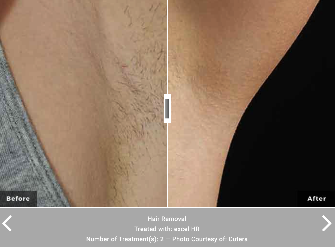 XEO Cutera Laser Hair Removal - Before and After - Rancho Cucamonga, CA Shylee Skin & Wellness